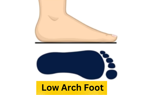 low-arch-foot